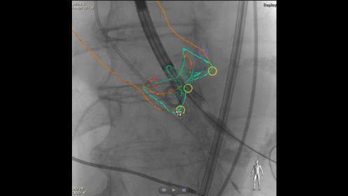 TAVI/TAVR live image guidance