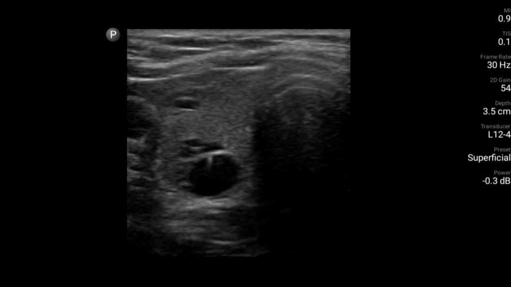  Transverse thyroid with lesion shown using L12-4 transducer on Lumify.