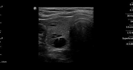 Transverse thyroid with lesion shown using L12-4 transducer.