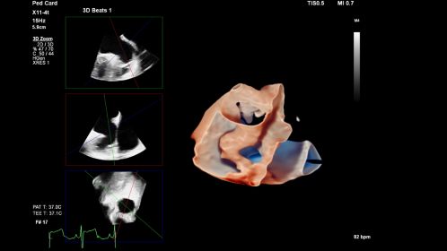 EPIQ CVx X11-4t Pediatric LAA