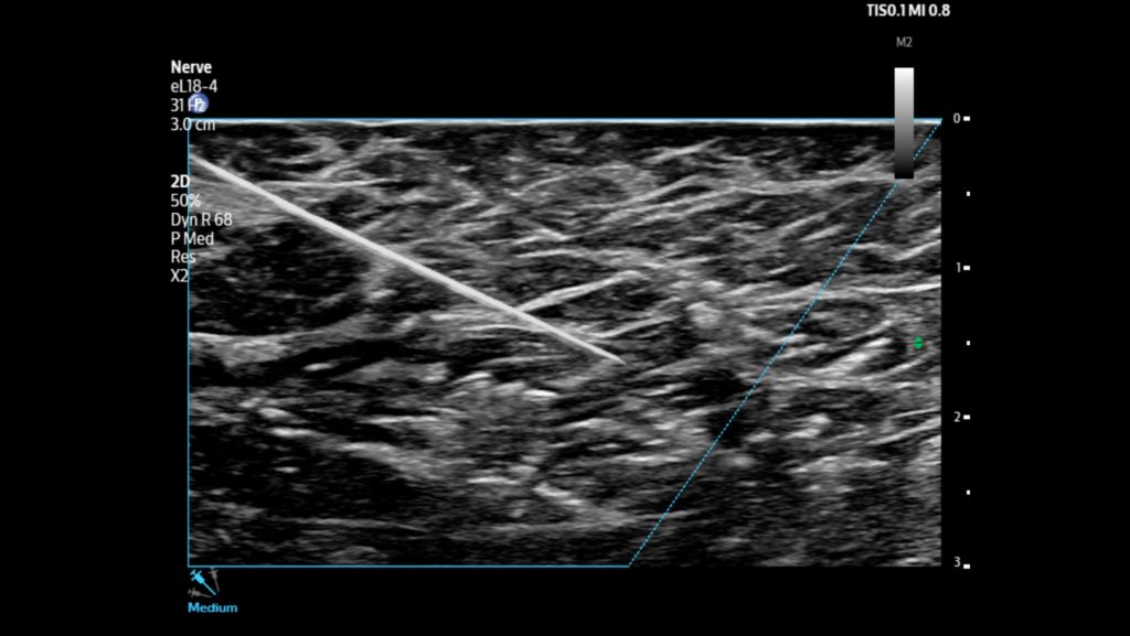Needle visualization shown using eL18 transducer.
