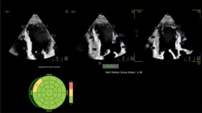 Philips cardiac ultrasound imaging showing wall motion score analysis
