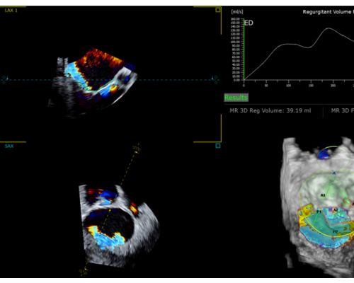 Automatic color flow quantification to assess mitral regurgitation