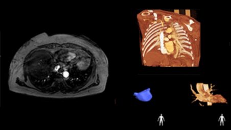 EP navigator and reduced 3D rotational scan