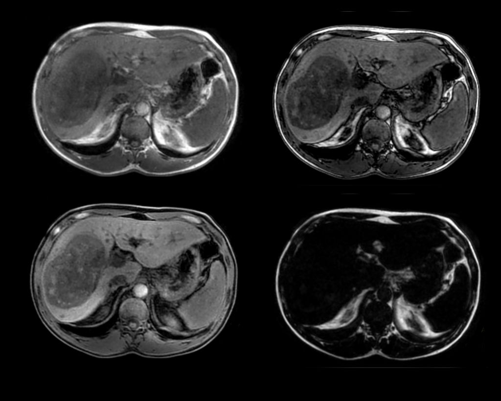 Axial mDIXON XD FFE (In Phase, Out Phase, Water only, Fat only)