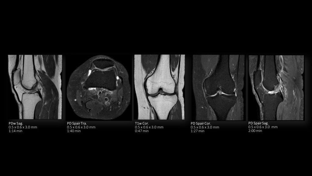 Knee on MR 5300 with SmartSpeed