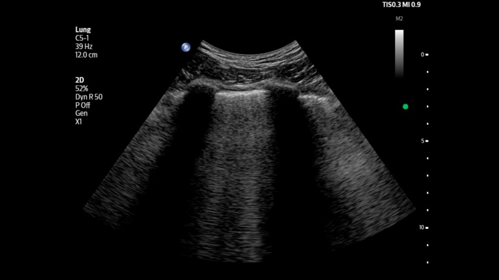 B-lines shown in the lungs using C5-1 transducer on Flash 5100 POC.