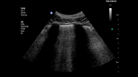 B-lines shown in the lungs using C5-1 transducer.