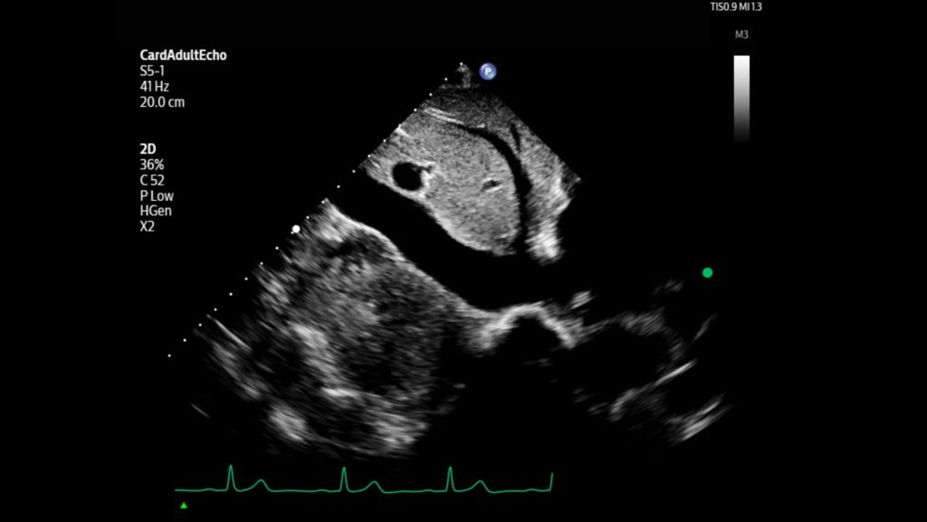 Adult echo subcoastal IVC shown using S5-1 transducer.