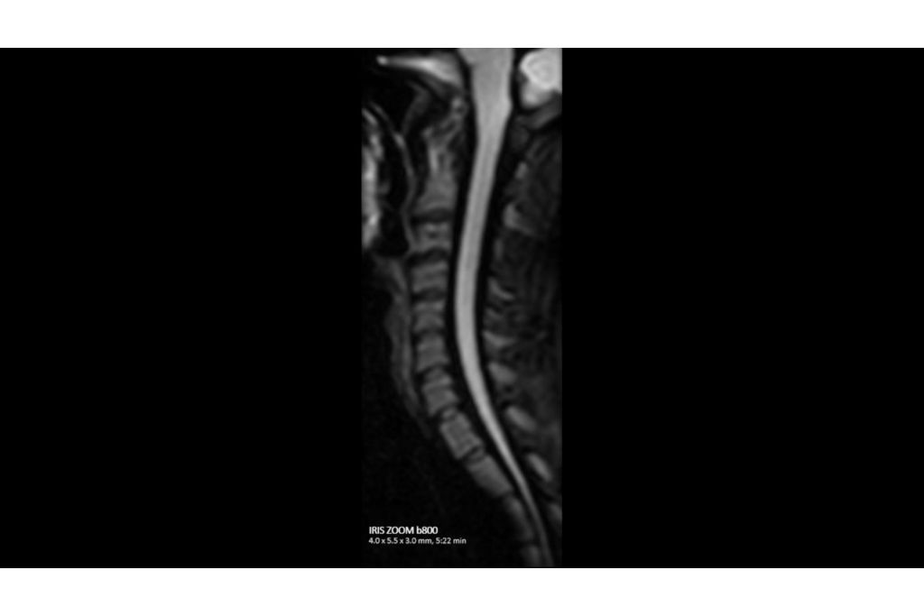 C-spine IRIS ZOOM b800