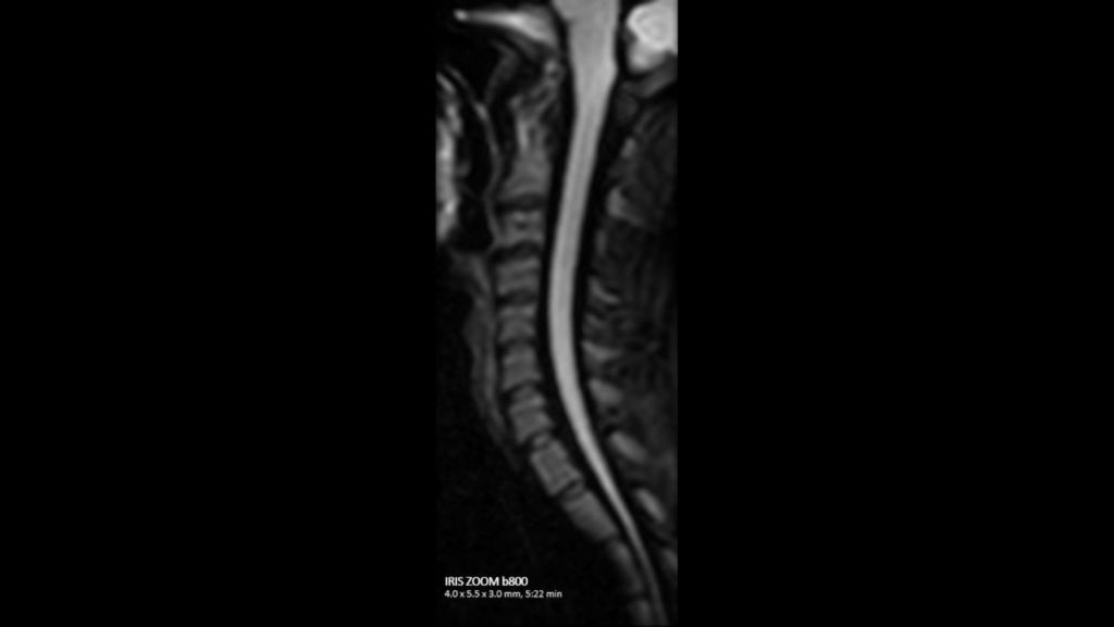 C-spine IRIS ZOOM b800