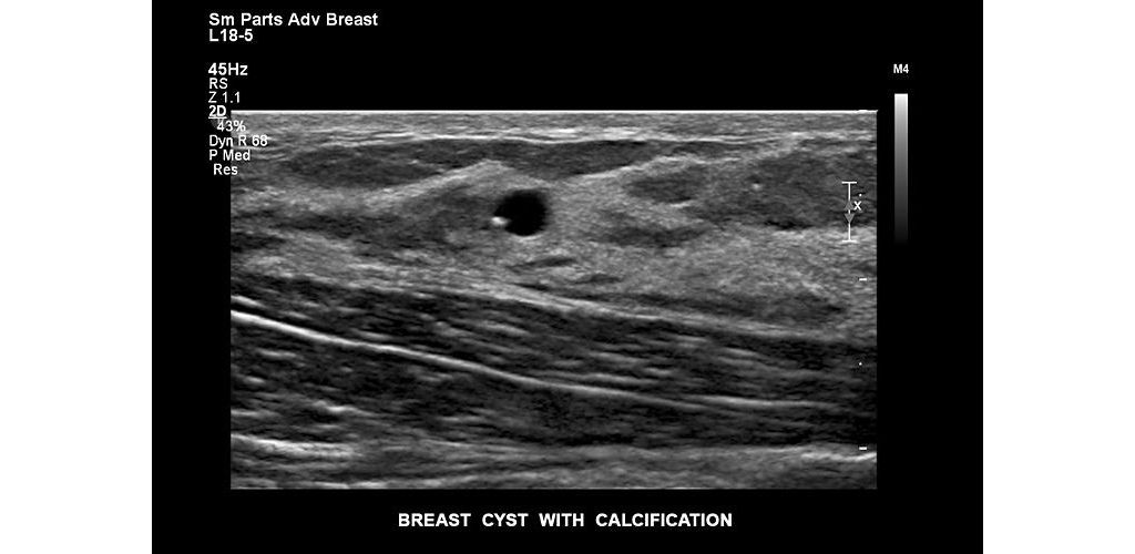 Breast cyst with calcification