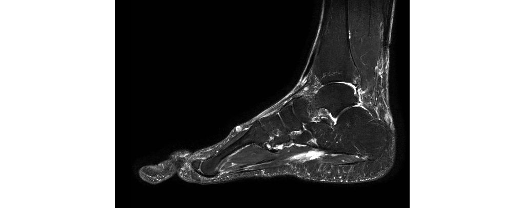 Sagittal mDIXON XD - T2w TSE (Water only)