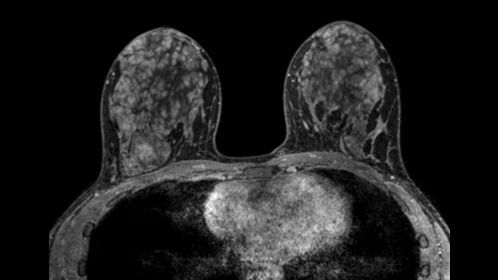 Breast MRI  MIC Medical Imaging