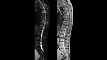 Fast, uniform, complete and consistent fat-free imaging