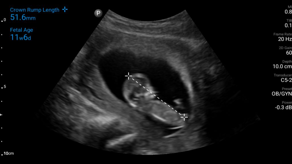 11 week, 6 day, OB with crown rump length (CRL) measurement shown using C5-2 transducer.