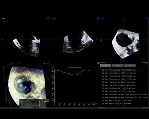 Segmental wall motion score, ai software application interface