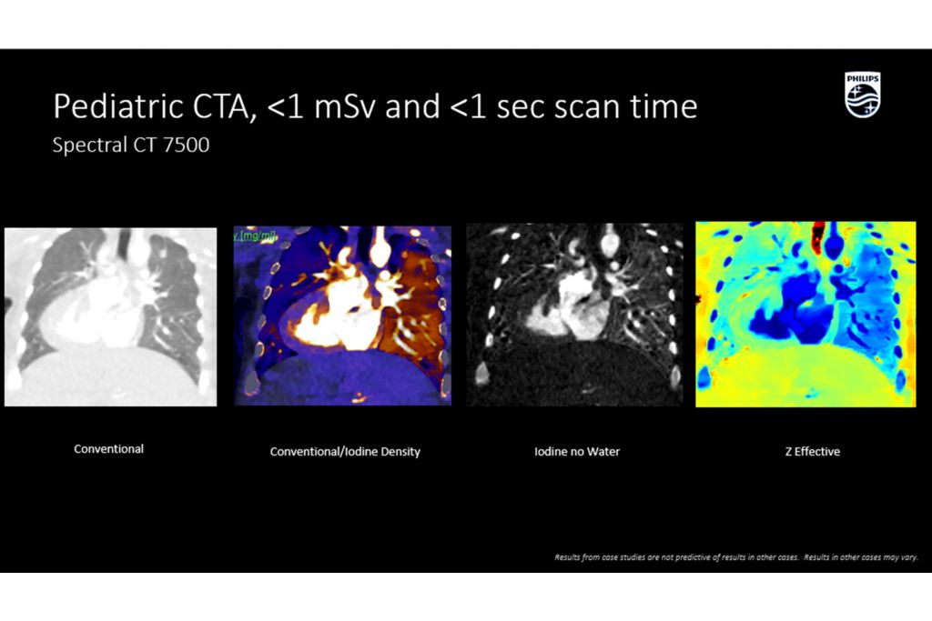 CT Spectral 7500 Pediatric CTA