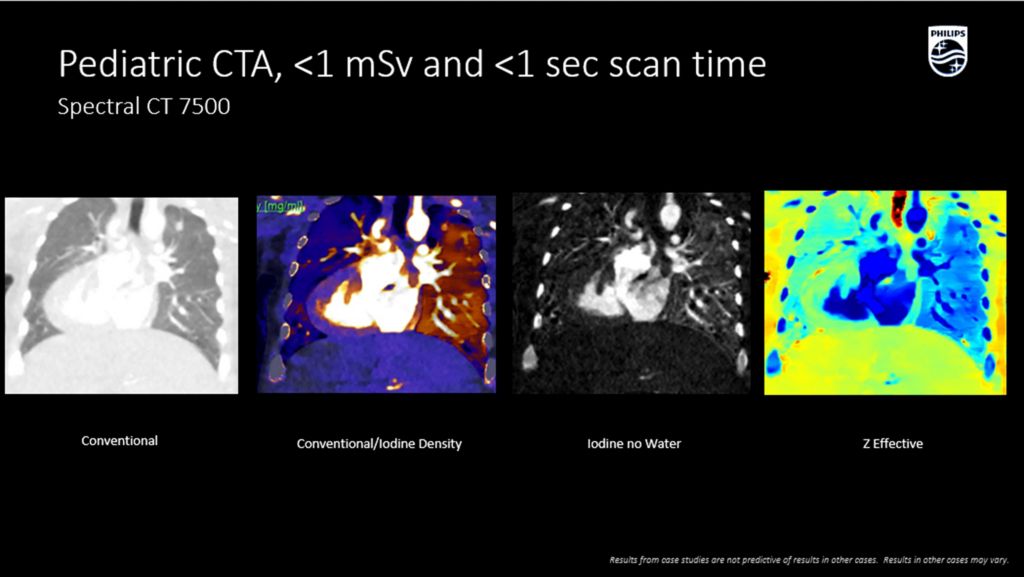 CT Spectral 7500 Pediatric CTA