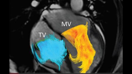 Flusso RM 4D² ³ per cuore e arterie principali