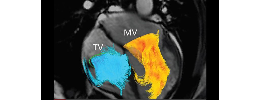 MR 4D flow² ³  for heart and main arteries