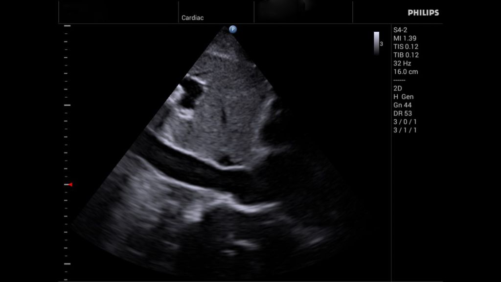 S4-2 Inferior Venacava