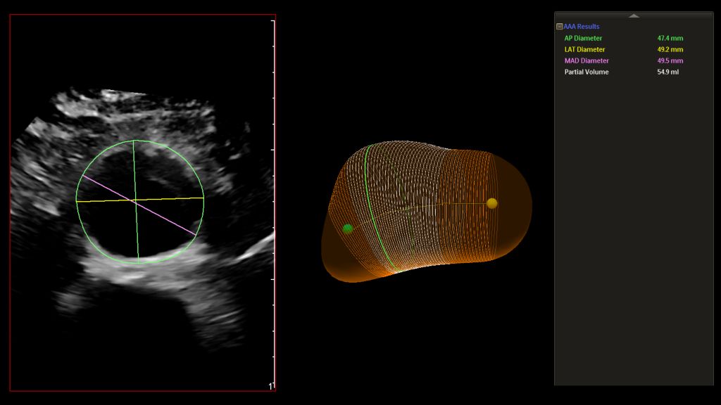 EPIQ X6-1_AAA Gallbladder Measurements