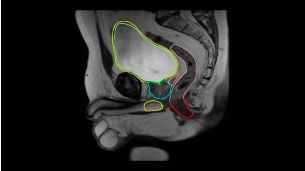 MRCAT Prostate + Auto-Contouring 