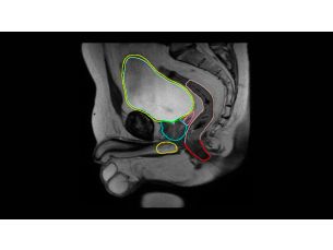 MRCAT Prostate + Auto-Konturierung Klinische MR-RT-Anwendung