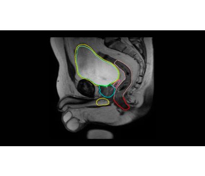 MRCAT Prostate + Auto-Contouring