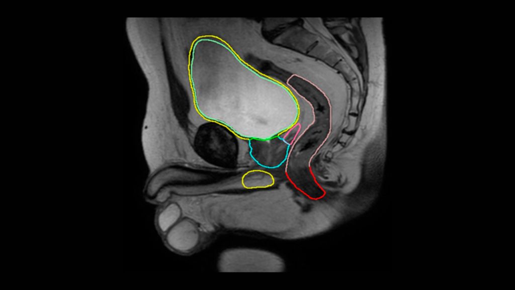 MRCAT Prostate + Auto-Contouring MR-RT clinical application