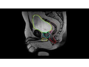 MRCAT Prostate + Auto-Contouring Application clinique de radiothérapie guidée par IRM