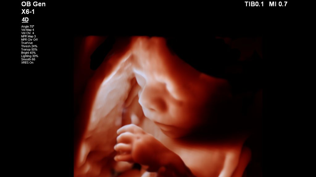 3D image of 27 week fetus with TrueVue and X6-1 transducer