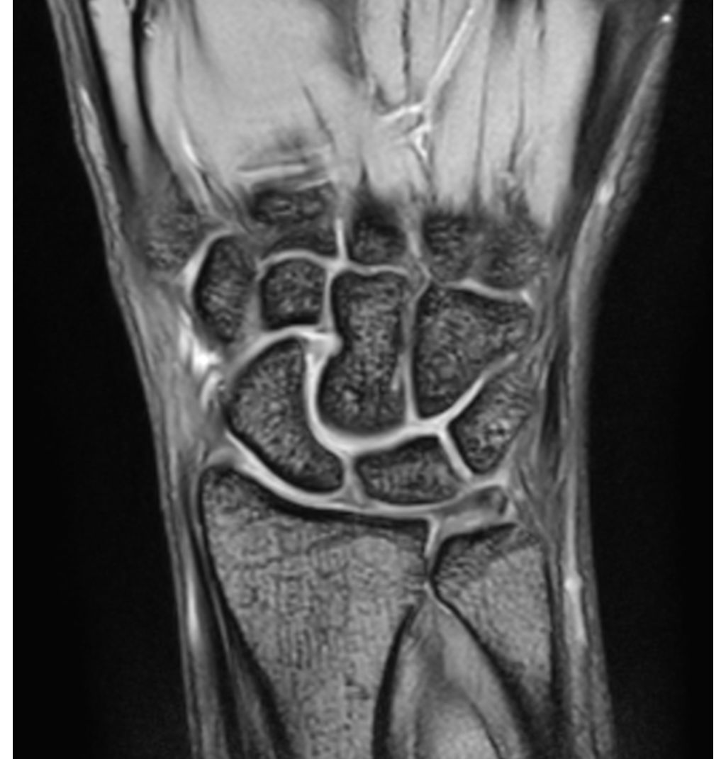 Coronal mFFE
