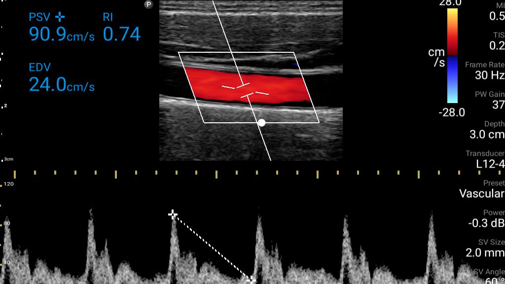 Common carotid artery with color, Pulsed Wave Doppler and resistive index (RI) shown using L12-4 transducer.