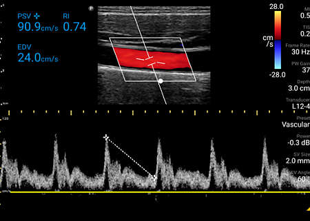Common carotid artery with color, Pulsed Wave Doppler and resistive index (RI) shown using L12-4 transducer.