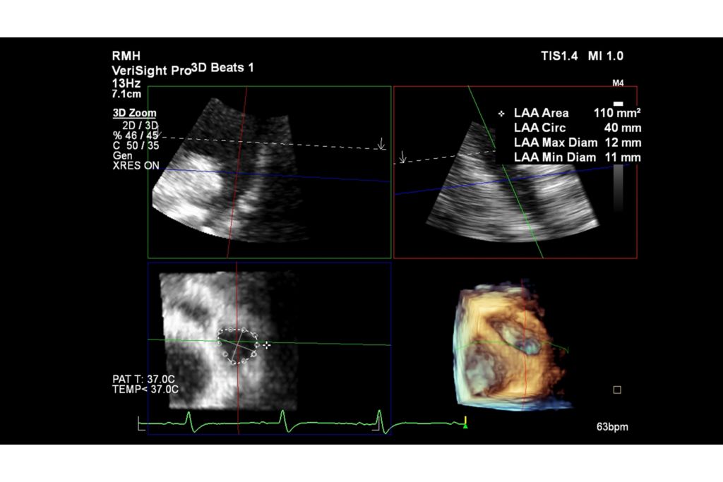 Left atrial appendage 3D Auto LAA