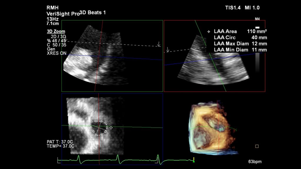 Left atrial appendage 3D Auto LAA