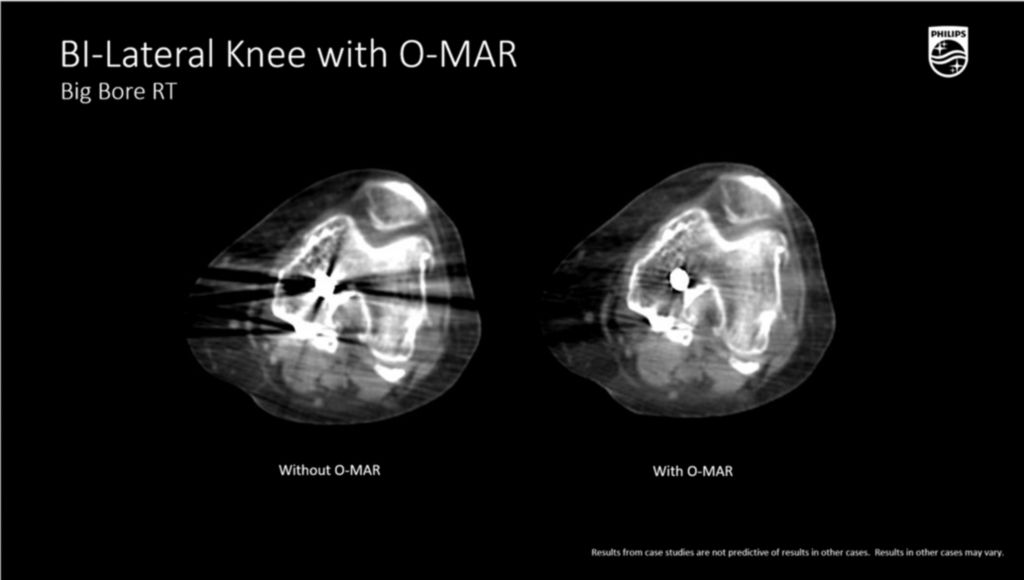 BBRT BI-lateral knee