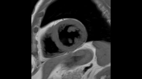 Black Blood imaging