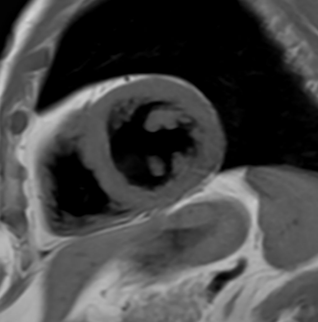 Black Blood imaging