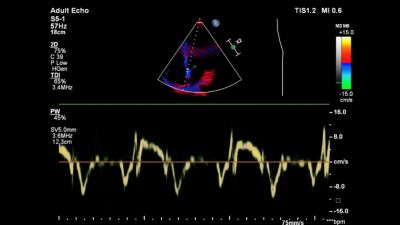 Doppler tkankowy (TDI)