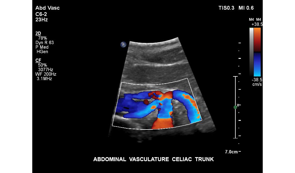 Abdominal vasculature celiac trunk