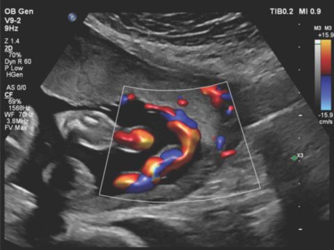 V9-2 transducer image of the placental cord insertion using color Doppler with Flow Viewer