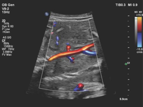 V9-2 transducer coronal image of the fetal aorta and normal bilateral renal arteries using color Doppler with Flow Viewer