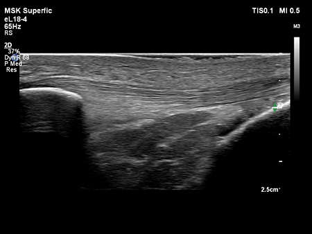eL18-4 MSK Patellar Tendon