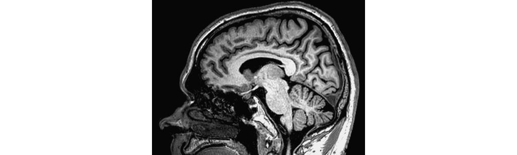 Non-selective 3D T1w TFE

