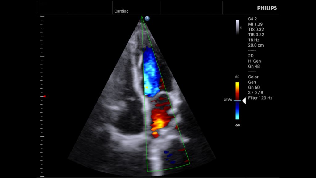 S4-2 Apical 4 Chamber Doppler
