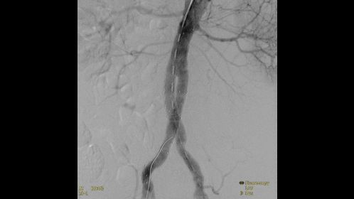 Clinical Image Philips Veradius Unity Mobile C-arm with Flat Detector