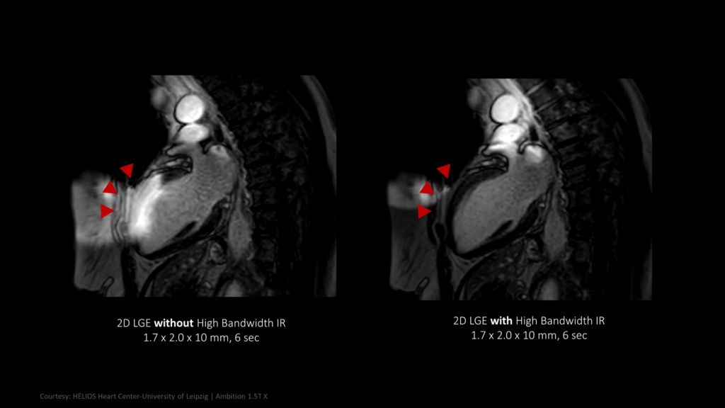 Myocardial viability exam for patients with cardiac implants with High Bandwidth IR